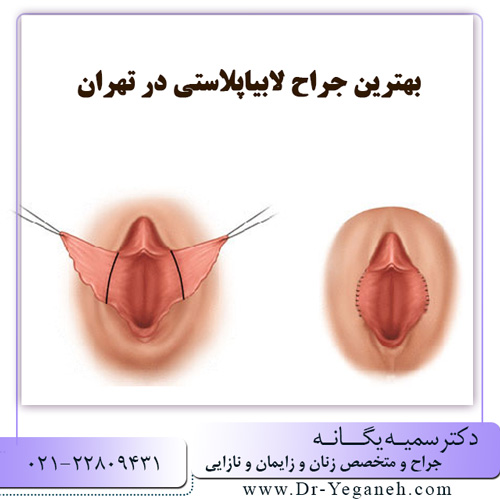 بهترین جراح لابیاپلاستی در تهران - دکتر یگانه