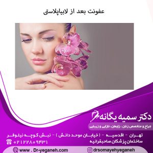 عفونت بعد از لابیاپلاستی
