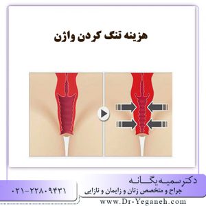 هزینه تنگ کردن واژن