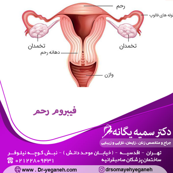 فیبروم رحم - دکتر یگانه 
