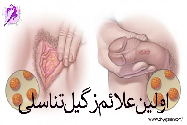 اولین علائم زگیل تناسلی - دکتر سمیه یگانه
