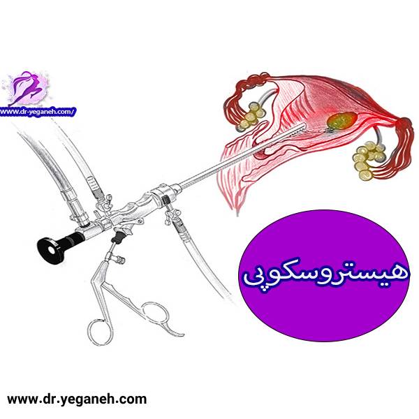 عکس هیستروسکوپی