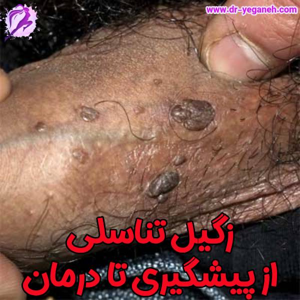 زگیل تناسلی