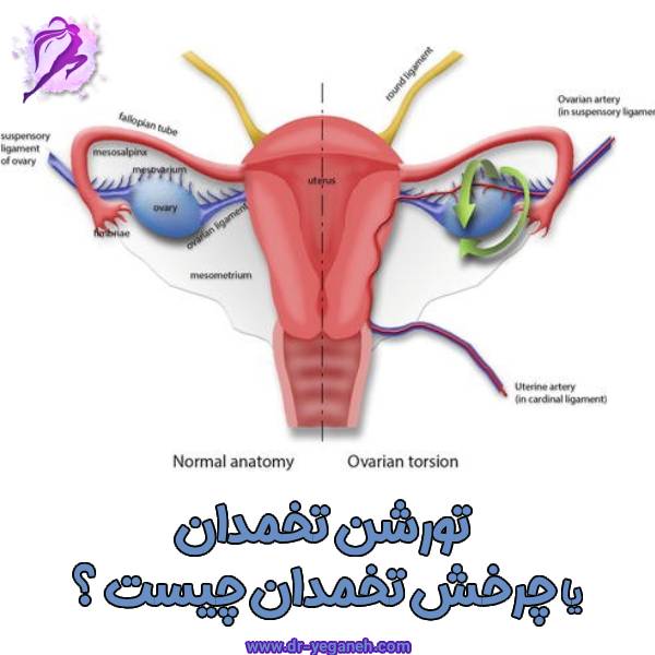 تورشن تخمدان - دکتر سمیه یگانه
