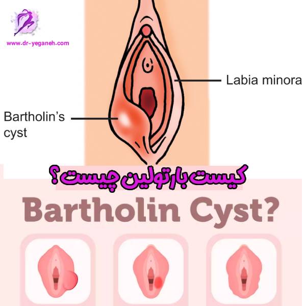 کیست بارتولین - دکتر سمیه یگانه