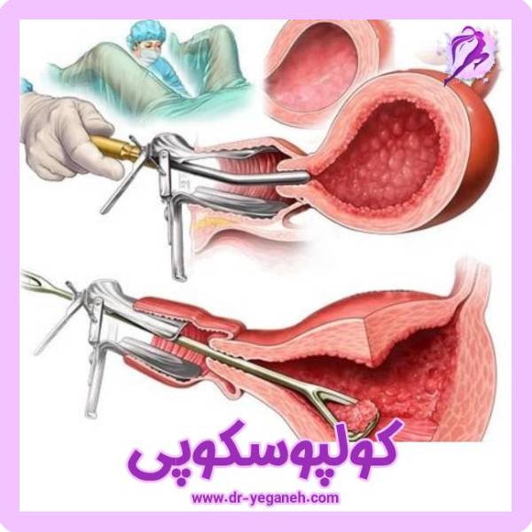 کولپوسکوپی - دکتر سمیه یگانه