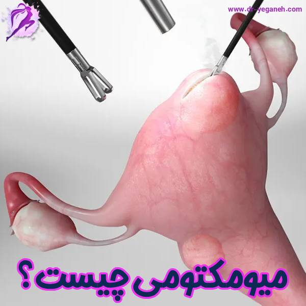 میومکتومی چیست؟ - دکتر سمیه یگانه